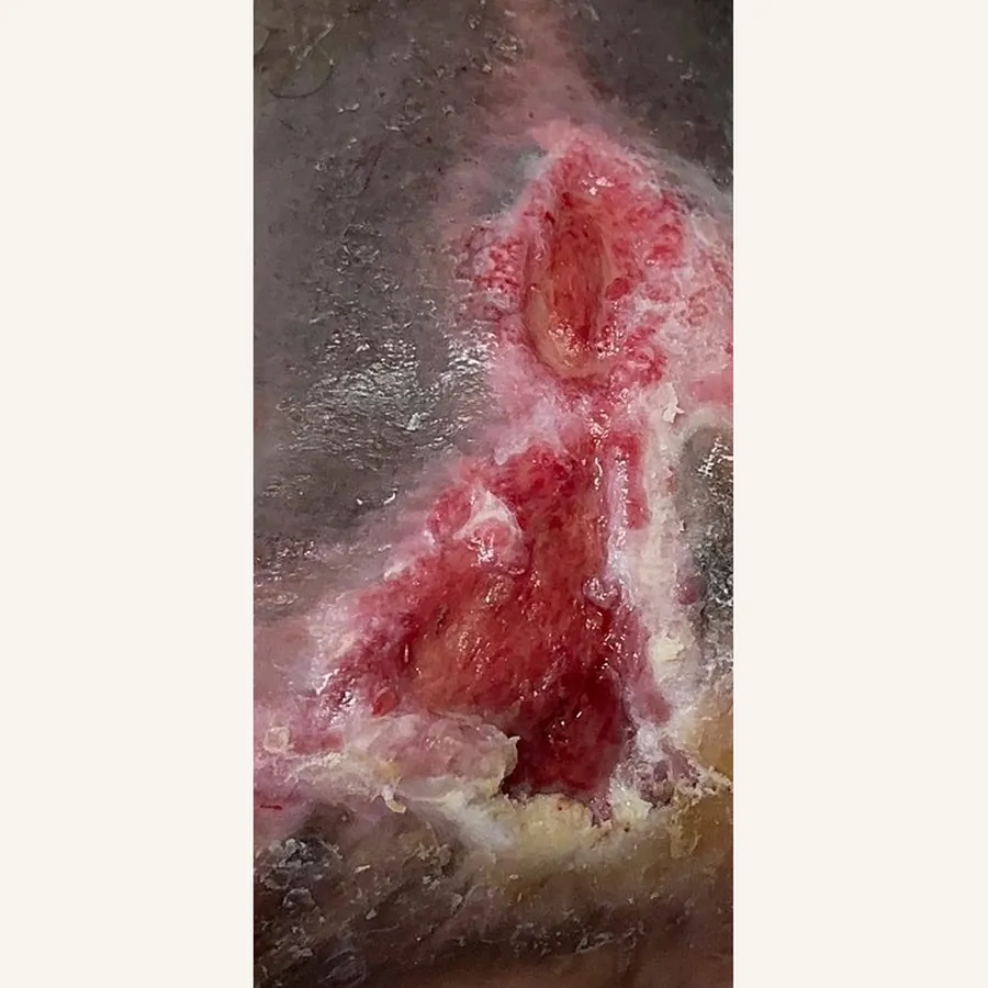 Clinical photograph of a diabetic foot wound at visit 5, HKL-77