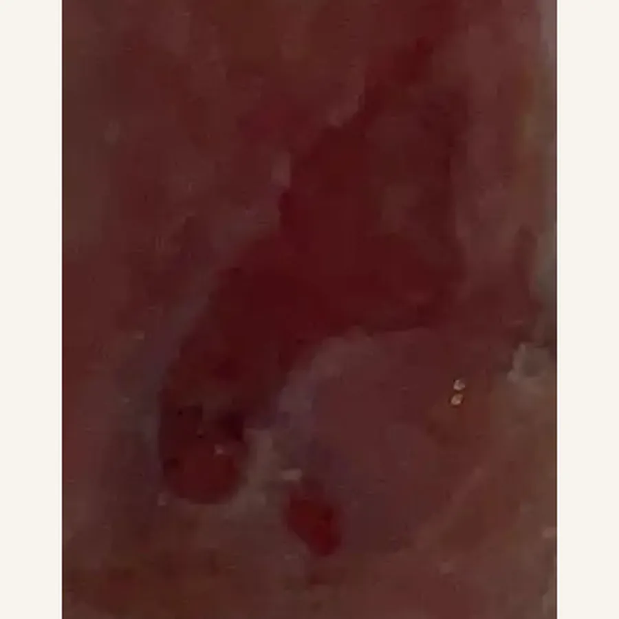Clinical photograph of a diabetic plantar wound at visit 1, HKL-78