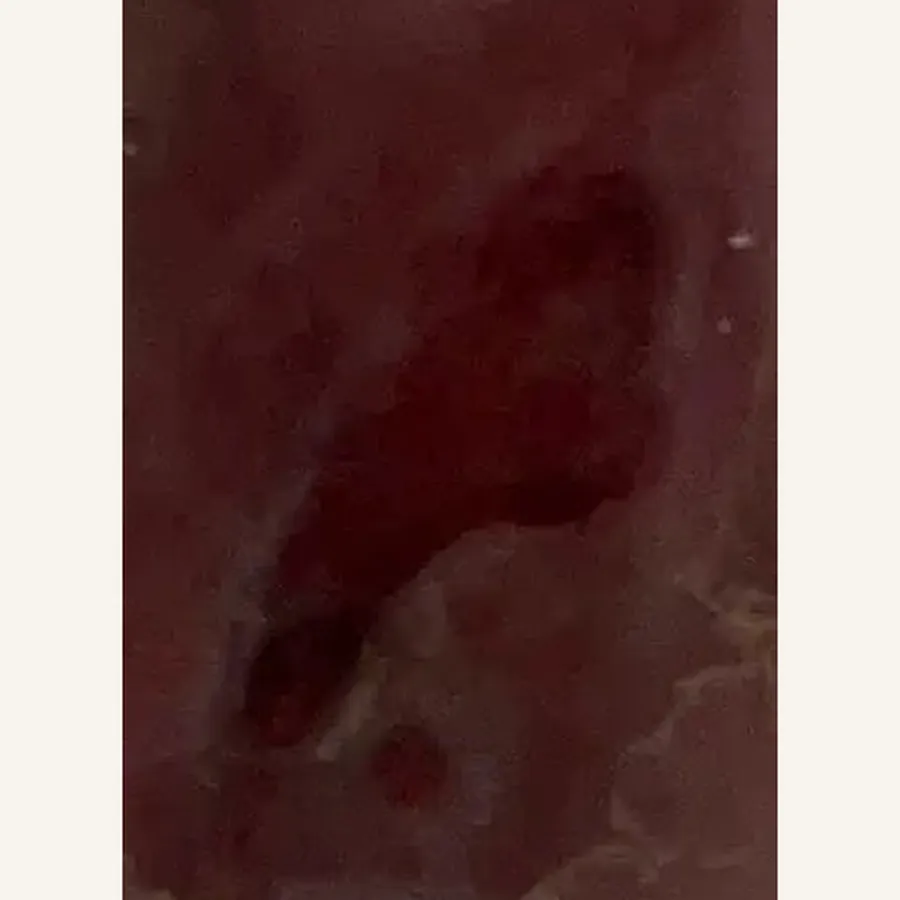 Clinical photograph of a diabetic plantar wound at visit 2, HKL-78