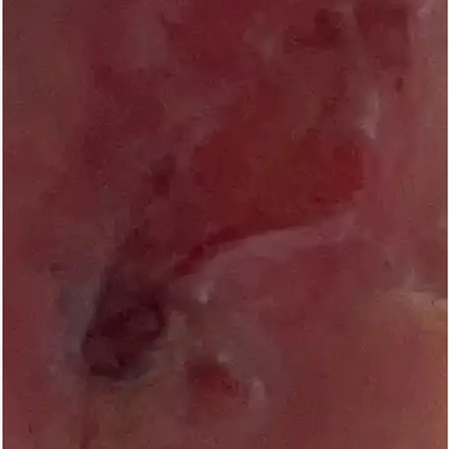 Clinical photograph of a diabetic plantar wound at visit 3, HKL-78