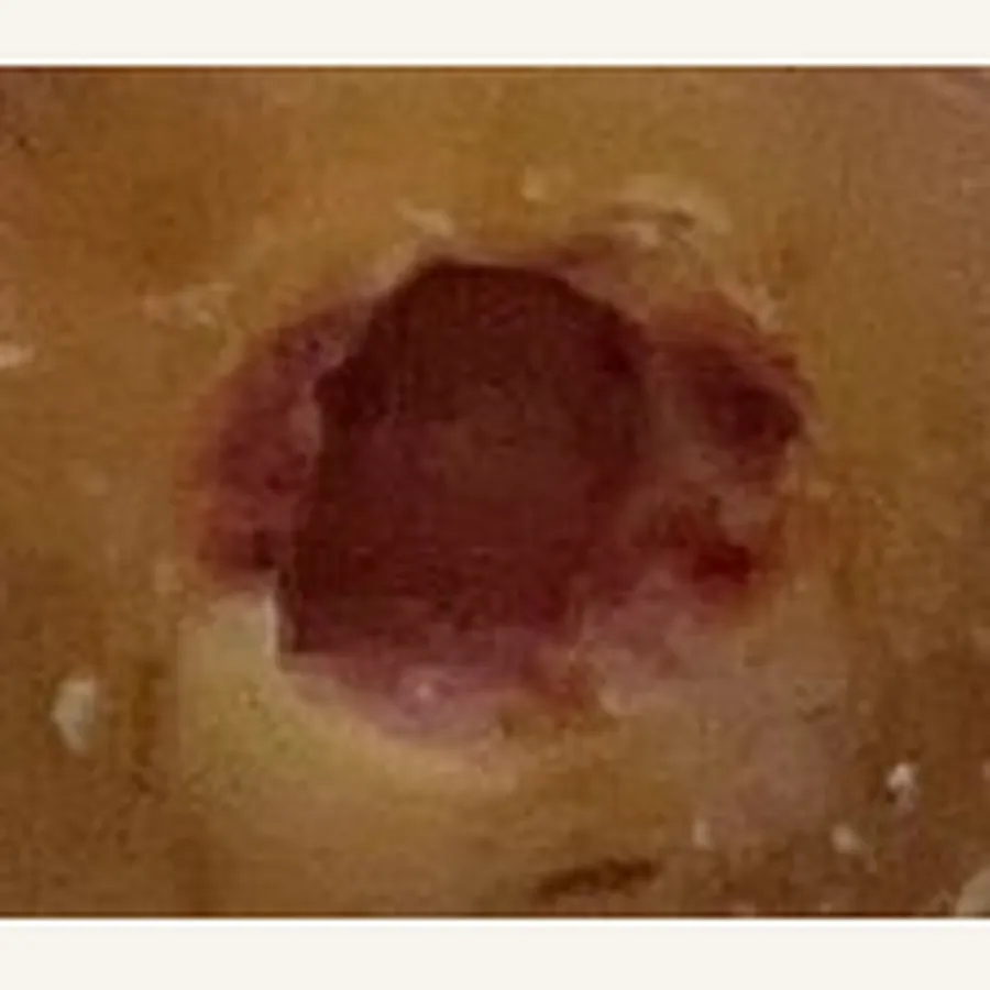 Clinical photograph of a diabetic plantar wound at visit 1, HKL-79