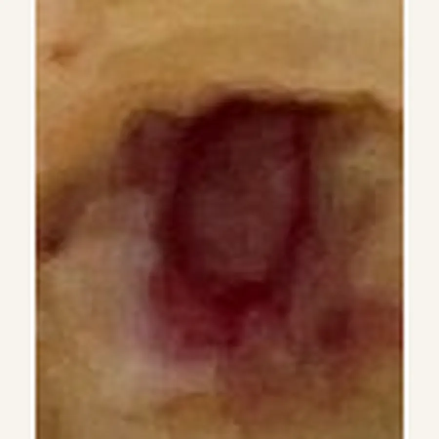 Clinical photograph of a diabetic plantar wound at visit 2, HKL-79