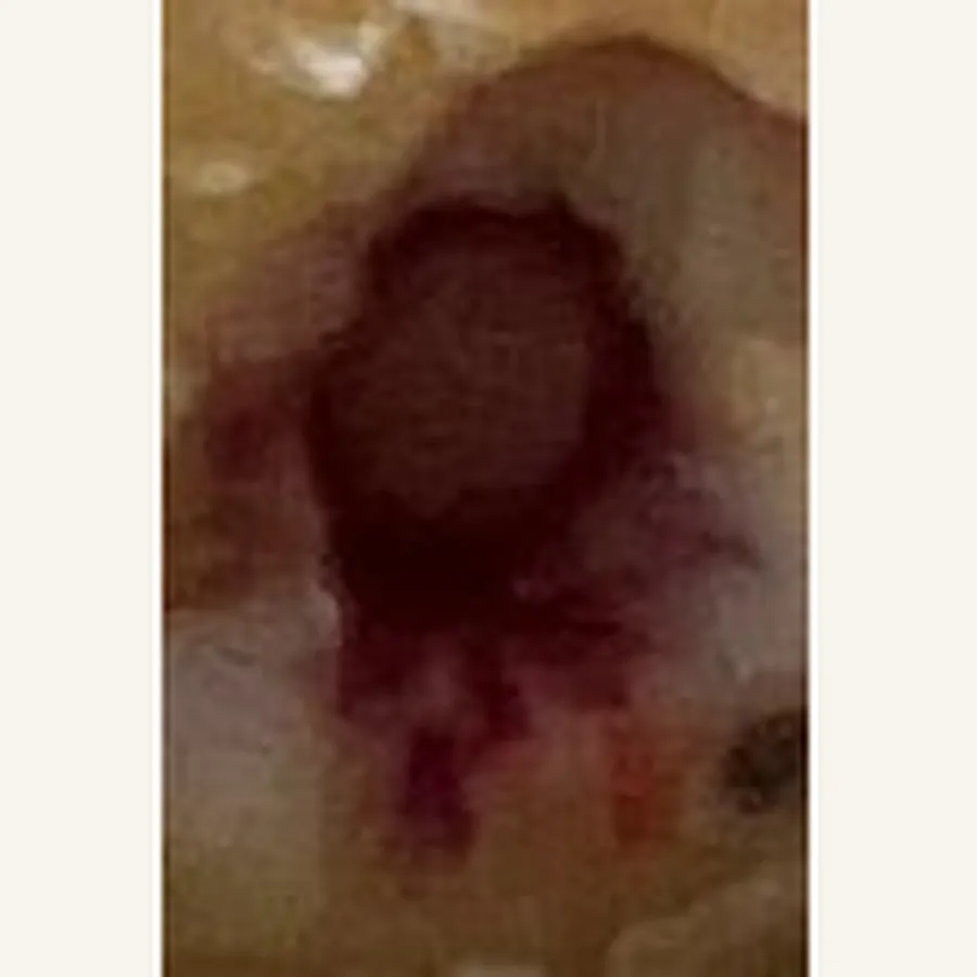Clinical photograph of a diabetic plantar wound at visit 3, HKL-79