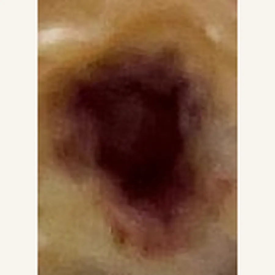 Clinical photograph of a diabetic plantar wound at visit 4, HKL-79