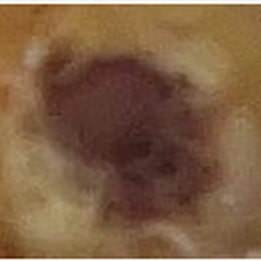 Clinical photograph of a diabetic plantar wound at visit 5, HKL-79