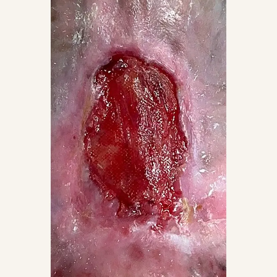 Clinical photograph of a lymphovascular leg wound at visit 1, HKL-80