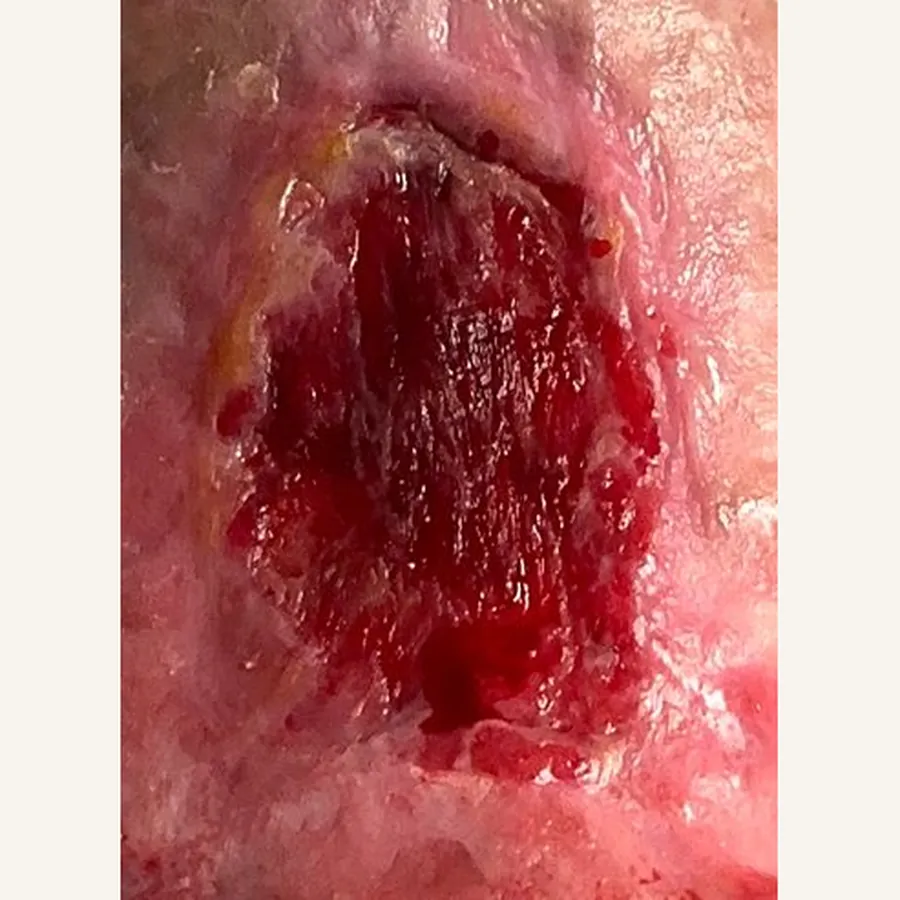 Clinical photograph of a lymphovascular leg wound at visit 2, HKL-80