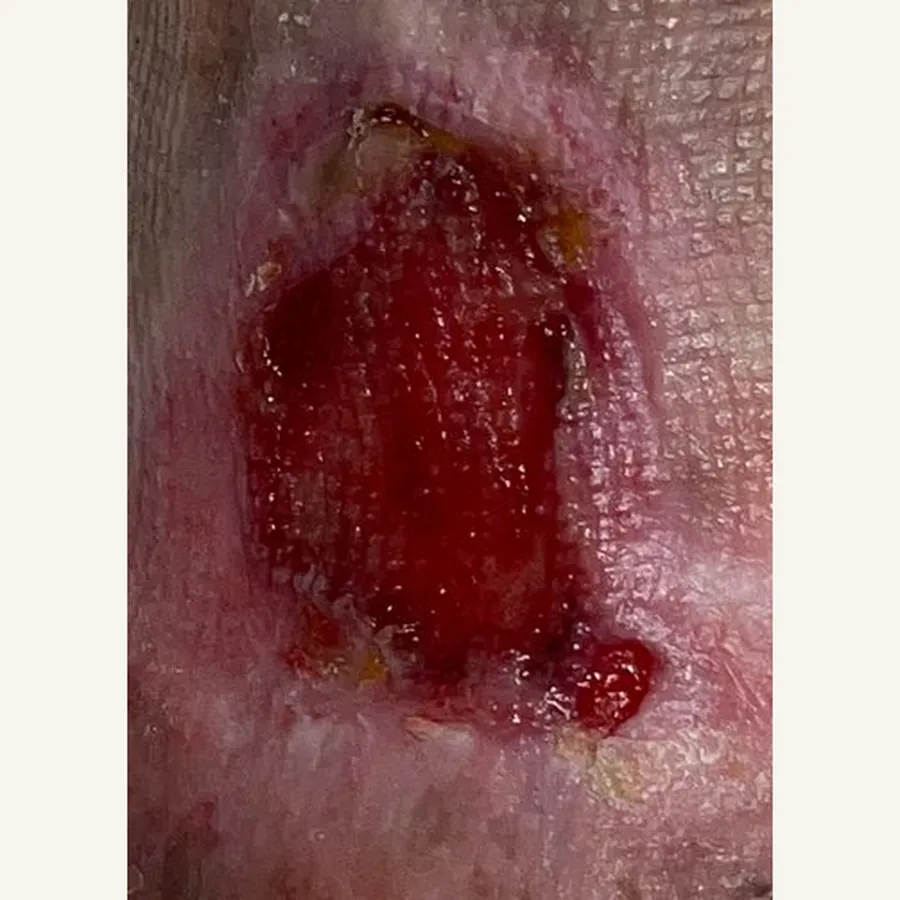 Clinical photograph of a lymphovascular leg wound at visit 3, HKL-80