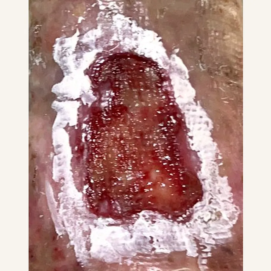 Clinical photograph of a lymphovascular leg wound at visit 4, HKL-80