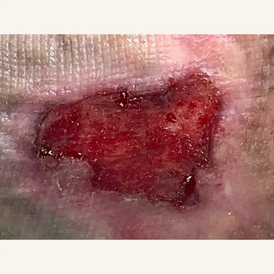 Clinical photograph of a lymphovascular leg wound at visit 5, HKL-80