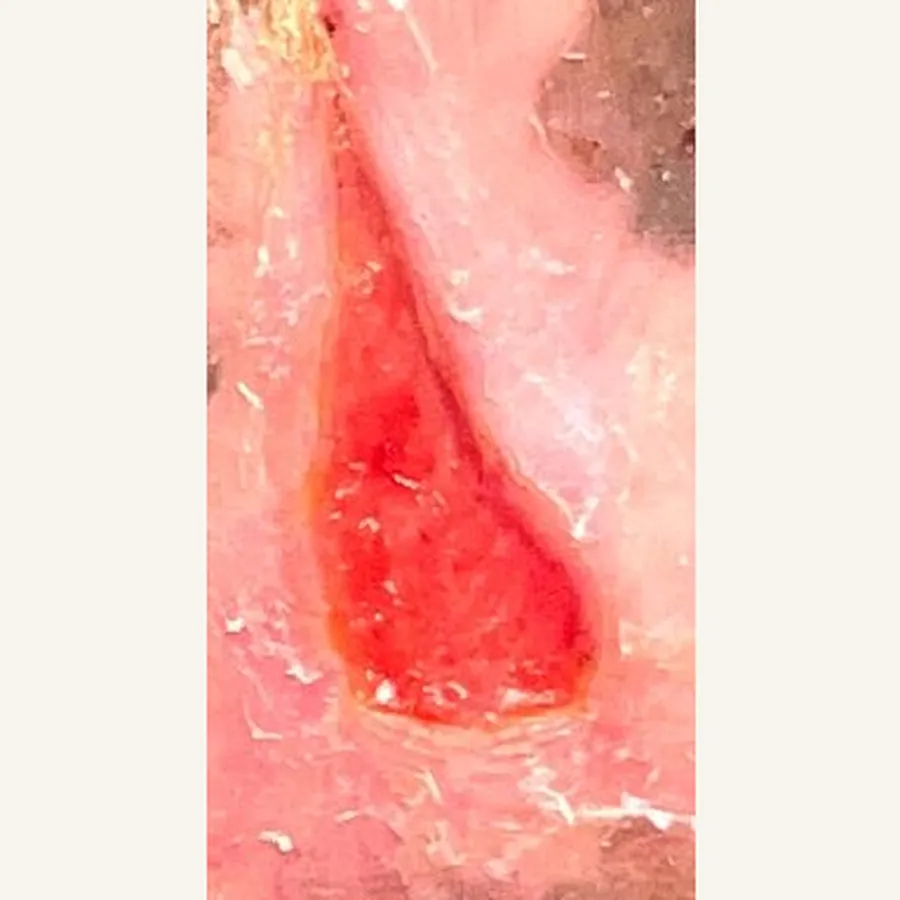 Clinical photograph of a diabetic foot wound at visit 1, HKL-81