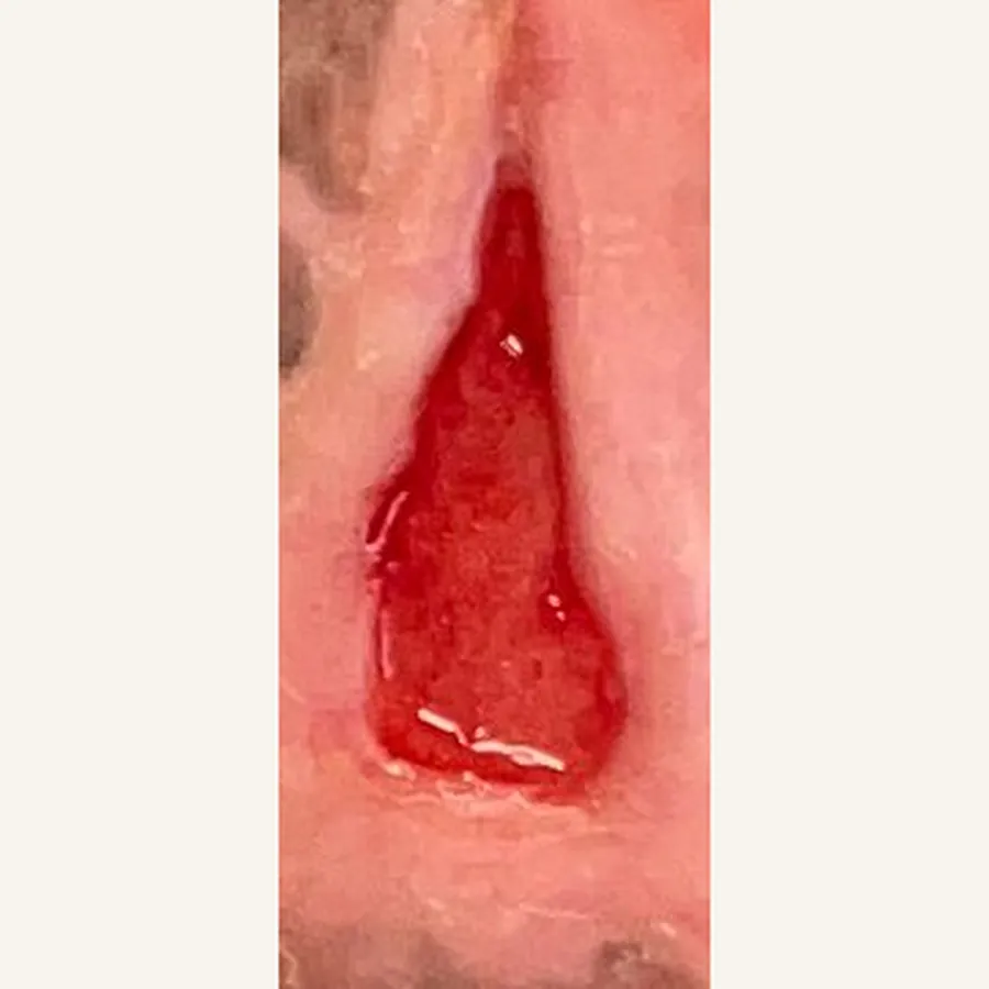 Clinical photograph of a diabetic foot wound at visit 2, HKL-81
