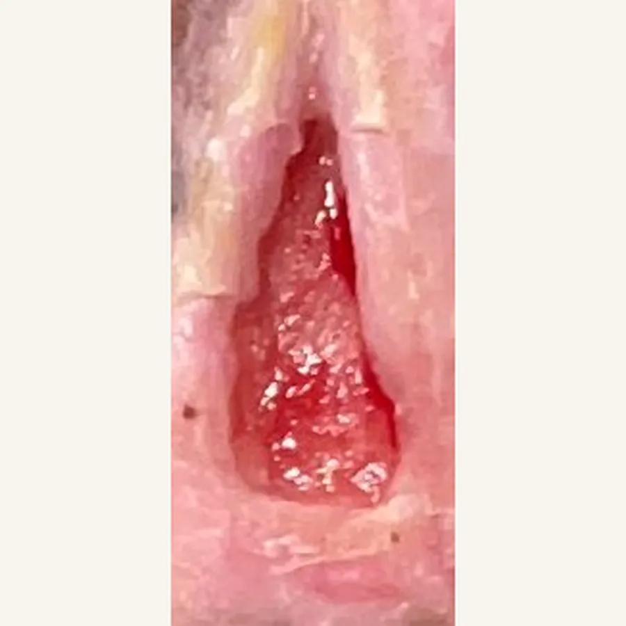 Clinical photograph of a diabetic foot wound at visit 3, HKL-81