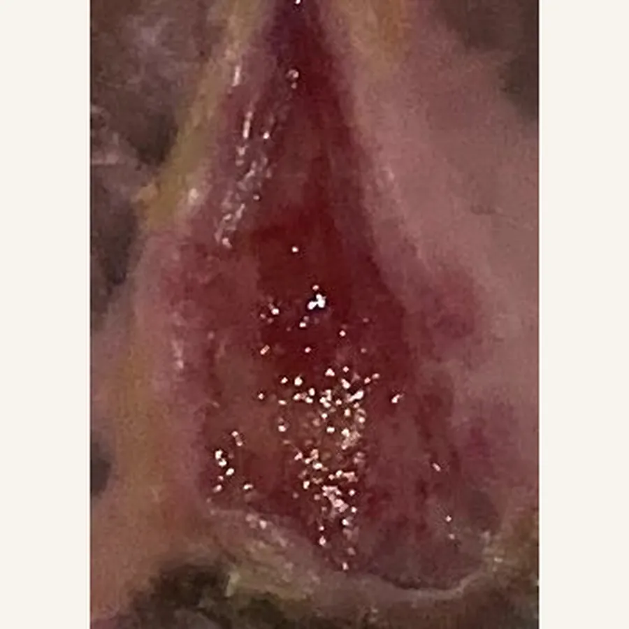 Clinical photograph of a diabetic foot wound at visit 5, HKL-81