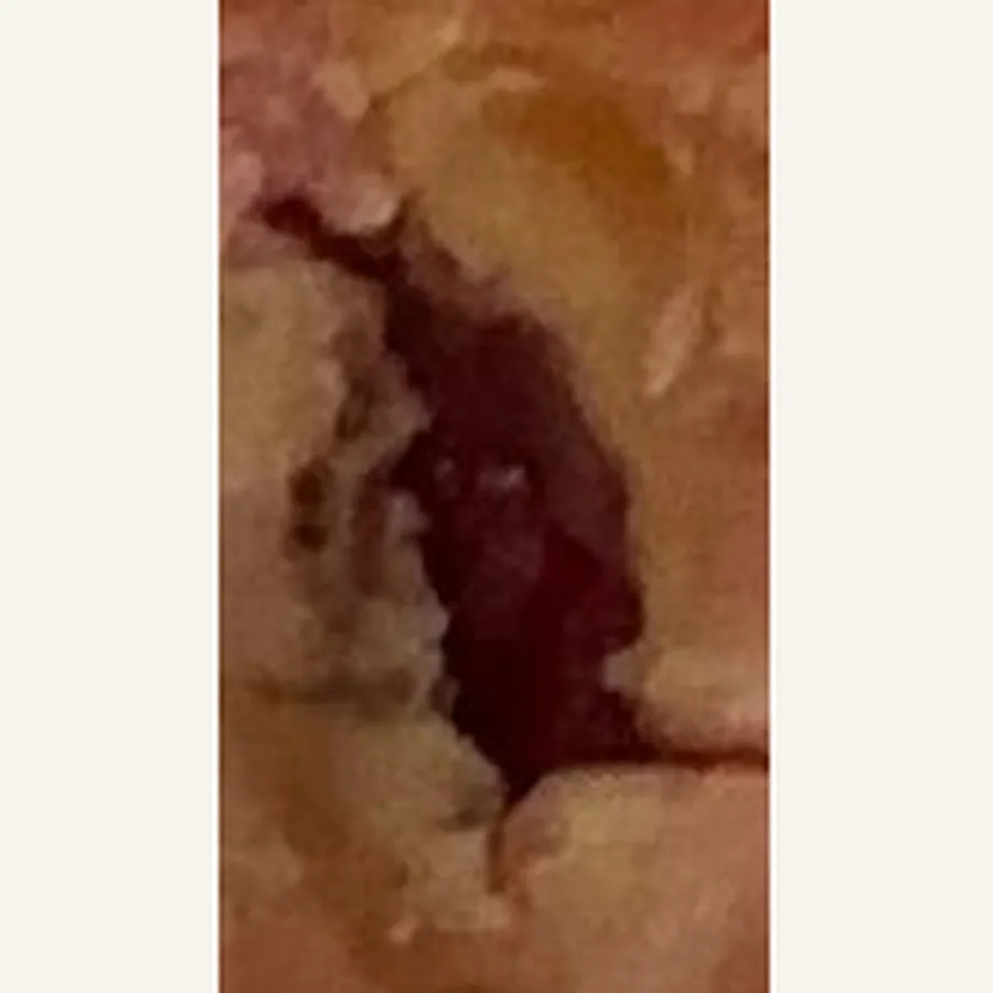 Clinical photograph of a diabetic plantar wound at visit 1, HKL-82