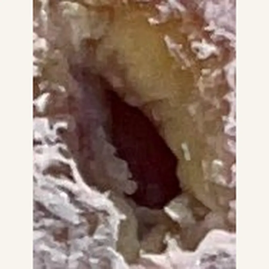 Clinical photograph of a diabetic plantar wound at visit 2, HKL-82