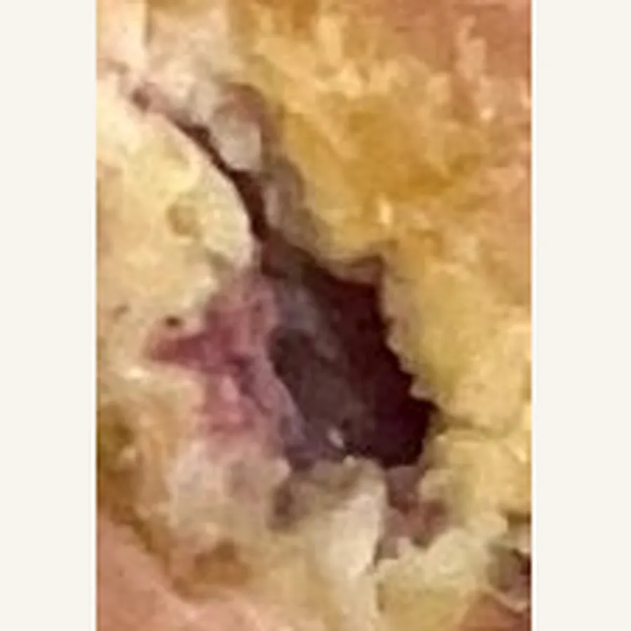 Clinical photograph of a diabetic plantar wound at visit 3, HKL-82