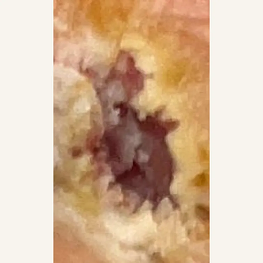 Clinical photograph of a diabetic plantar wound at visit 4, HKL-82