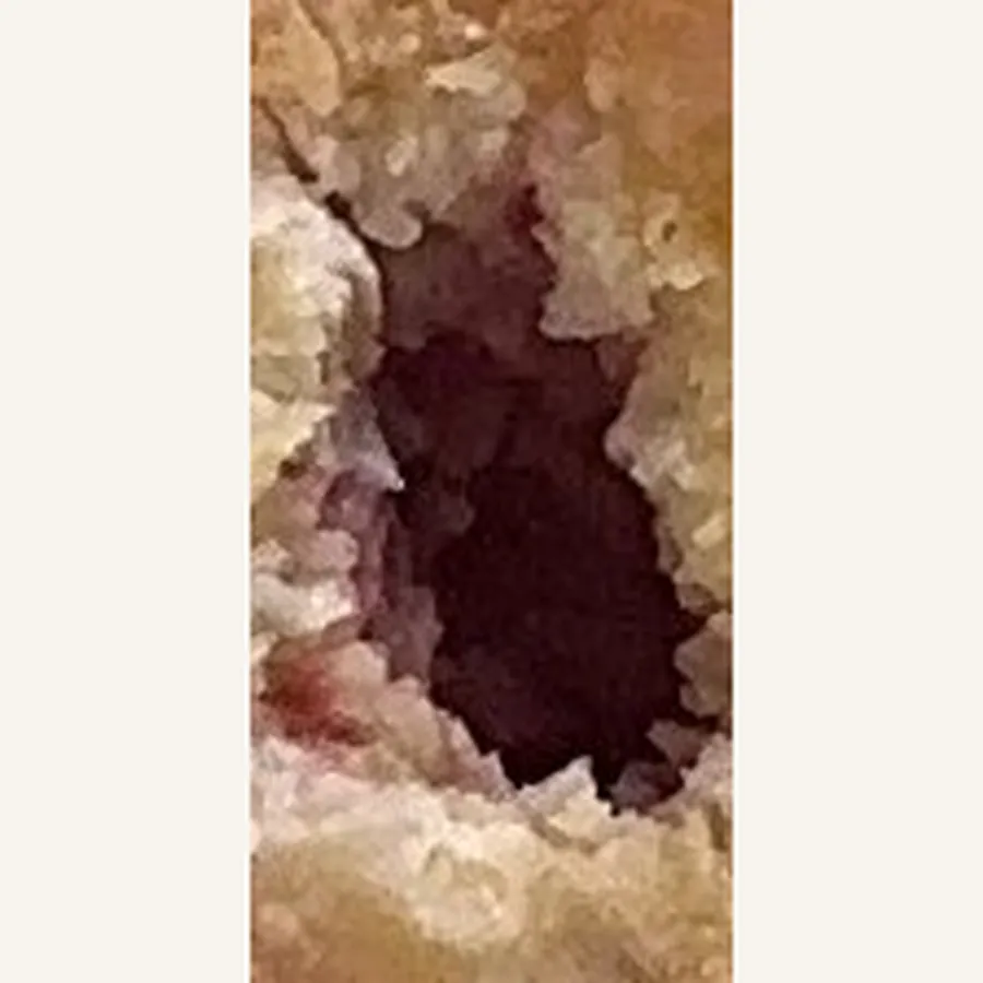 Clinical photograph of a diabetic plantar wound at visit 5, HKL-82