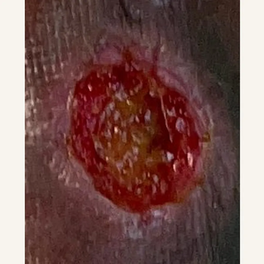 Clinical photograph of a lymphovascular leg wound at visit 1, HKL-83