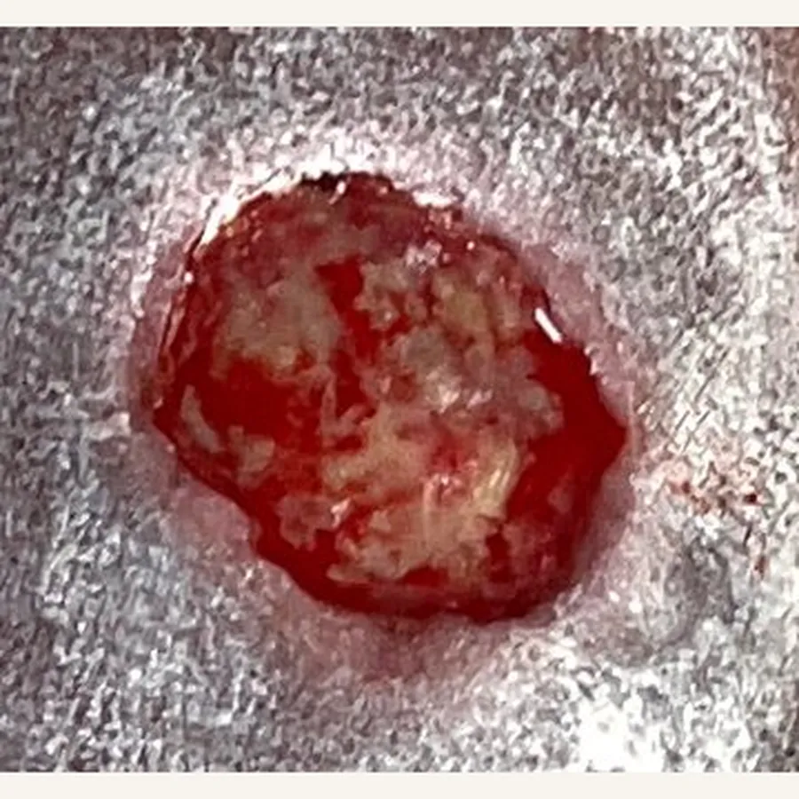Clinical photograph of a lymphovascular leg wound at visit 2, HKL-83