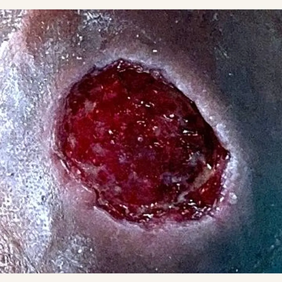 Clinical photograph of a lymphovascular leg wound at visit 3, HKL-83