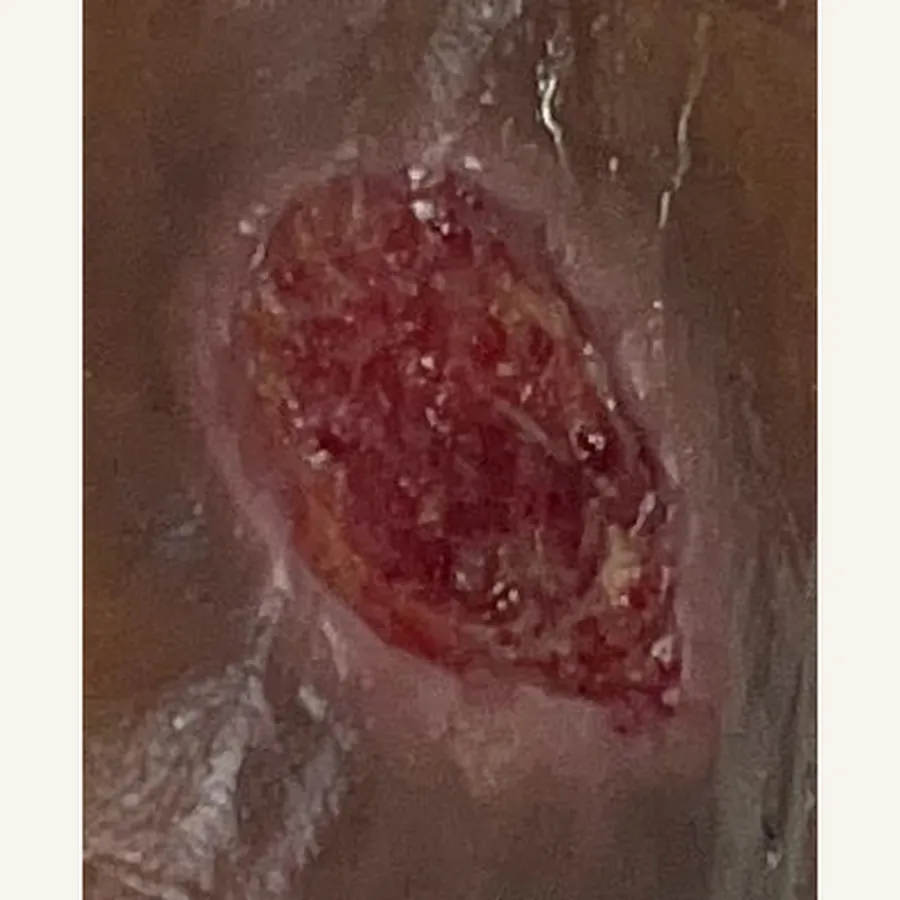 Clinical photograph of a lymphovascular leg wound at visit 4, HKL-83