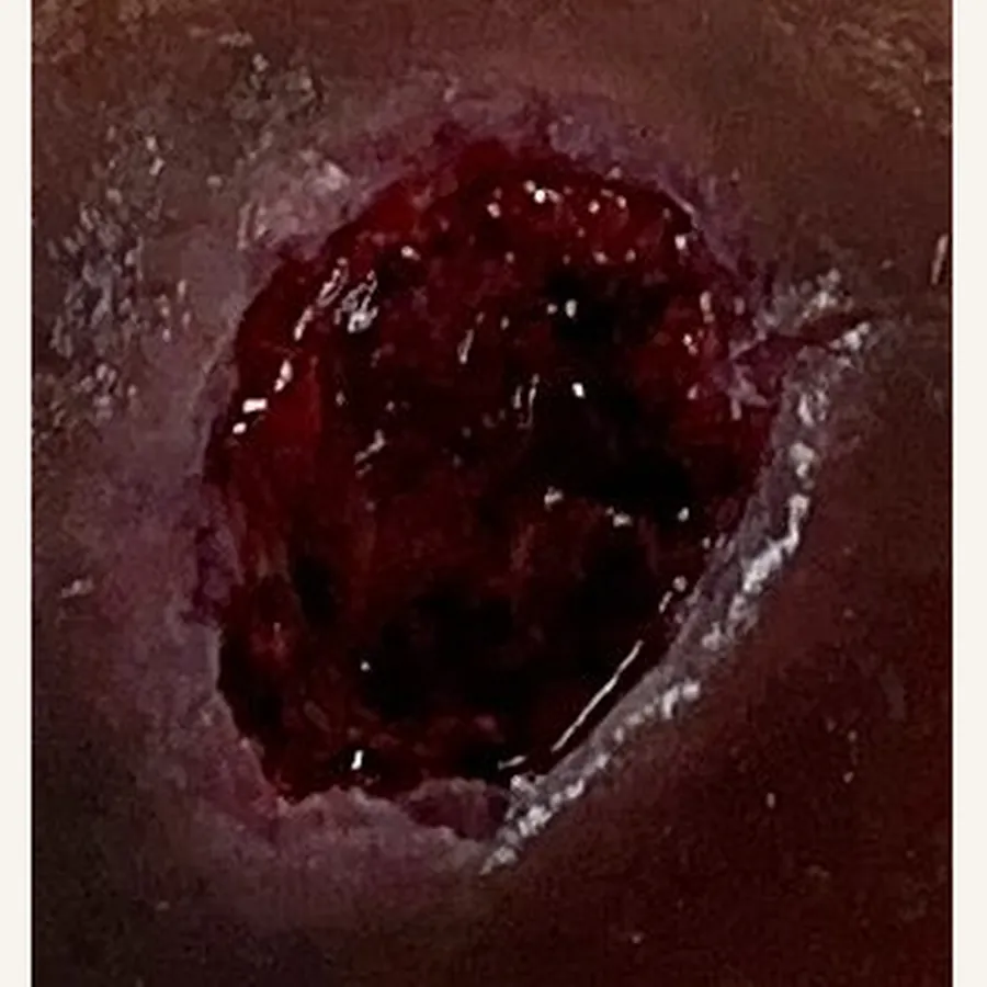 Clinical photograph of a lymphovascular leg wound at visit 5, HKL-83
