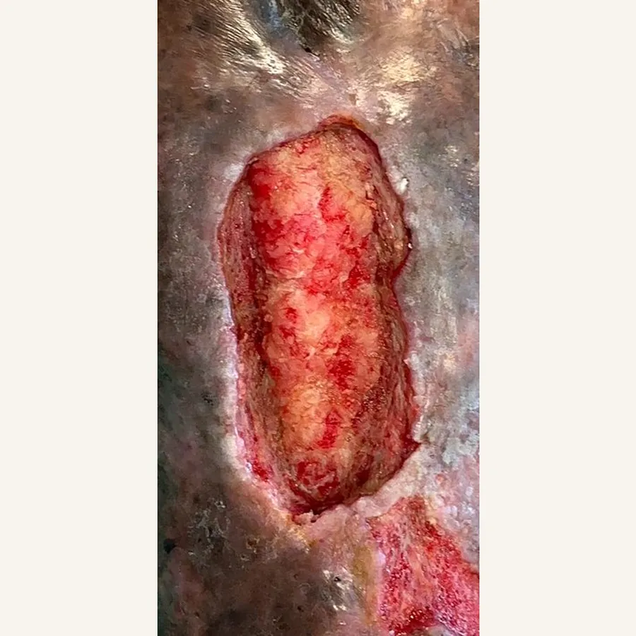 Clinical photograph of a trauma-related leg wound at visit 1, HKL-84