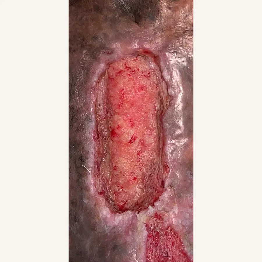 Clinical photograph of a trauma-related leg wound at visit 2, HKL-84