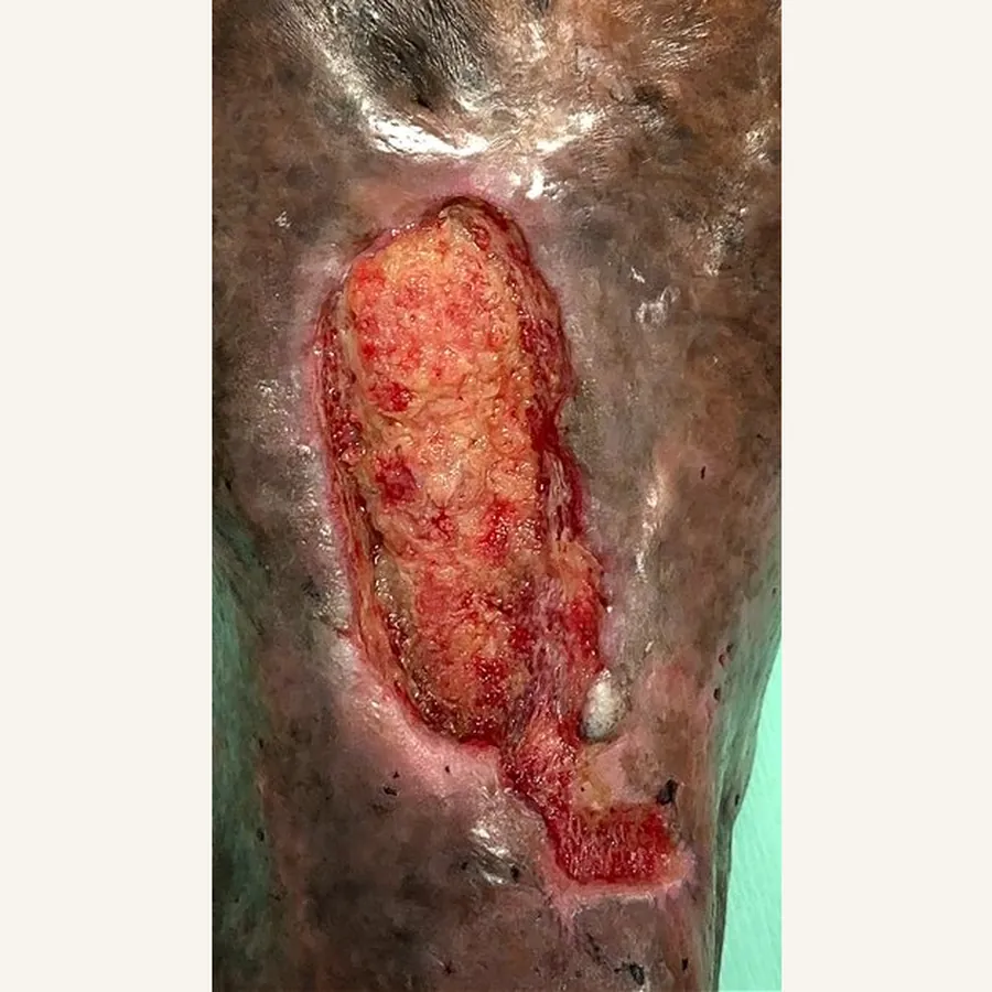 Clinical photograph of a trauma-related leg wound at visit 3, HKL-84