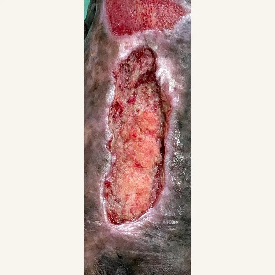 Clinical photograph of a trauma-related leg wound at visit 4, HKL-84