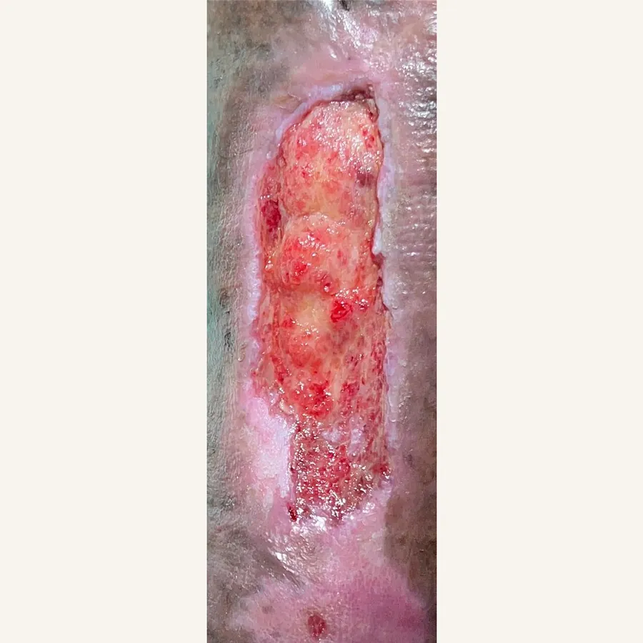 Clinical photograph of a trauma-related leg wound at visit 5, HKL-84