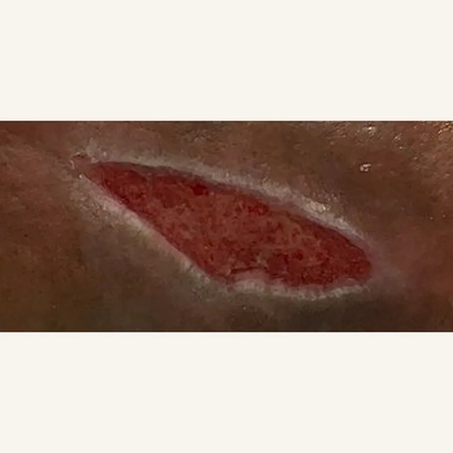 Clinical photograph of a diabetic leg wound at visit 1, HKL-85