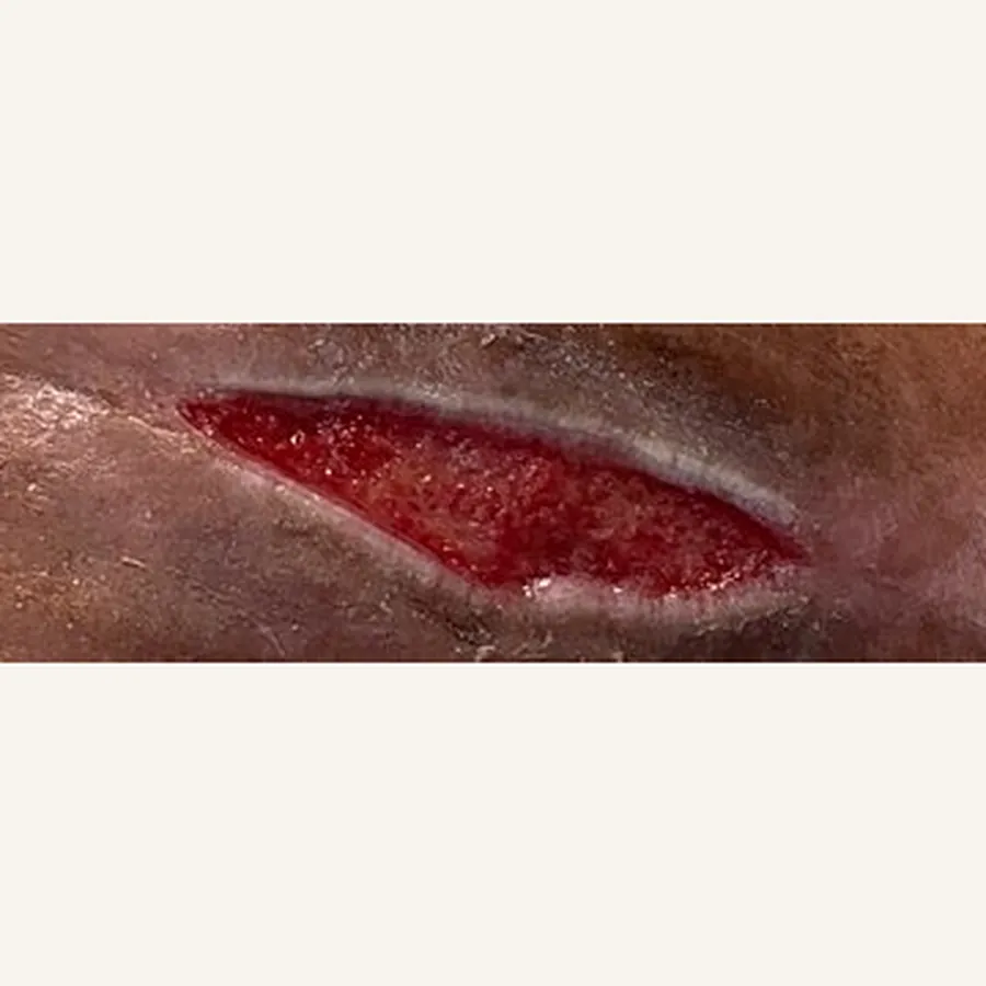 Clinical photograph of a diabetic leg wound at visit 2, HKL-85
