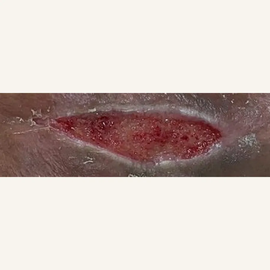 Clinical photograph of a diabetic leg wound at visit 3, HKL-85