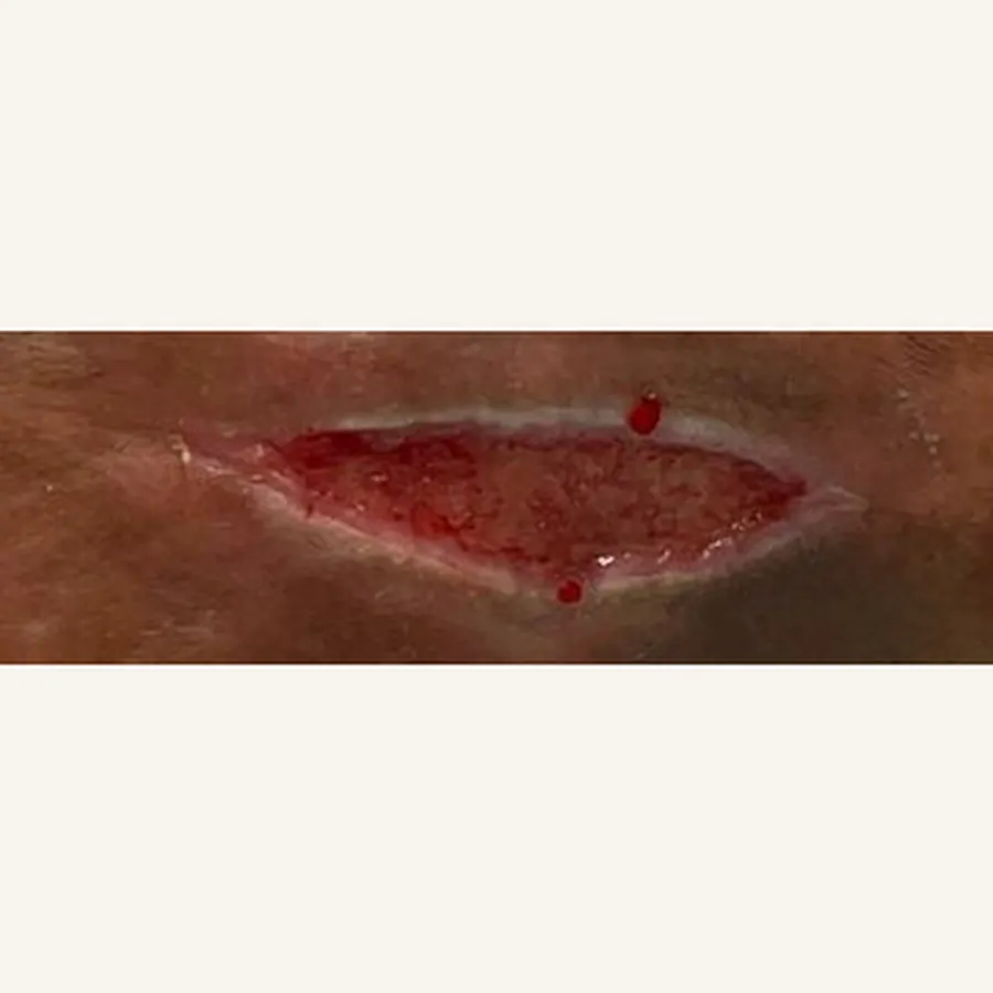 Clinical photograph of a diabetic leg wound at visit 4, HKL-85