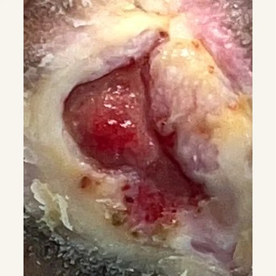 Clinical photograph of a diabetic plantar wound at visit 1, HKL-86