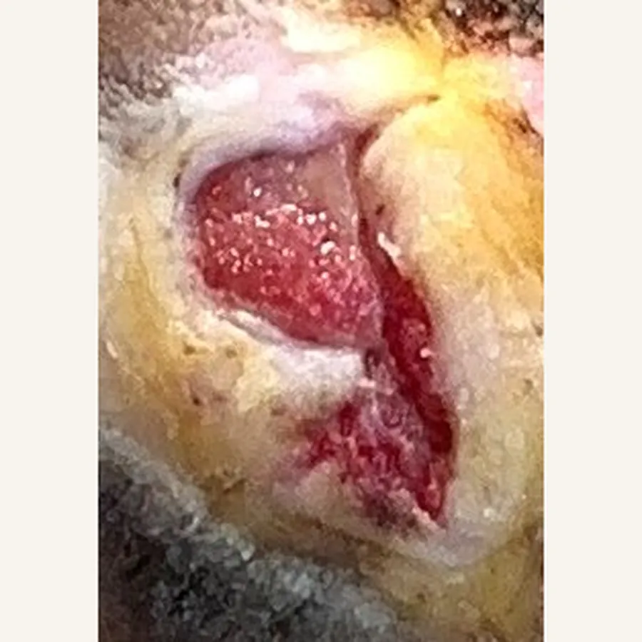 Clinical photograph of a diabetic plantar wound at visit 2, HKL-86