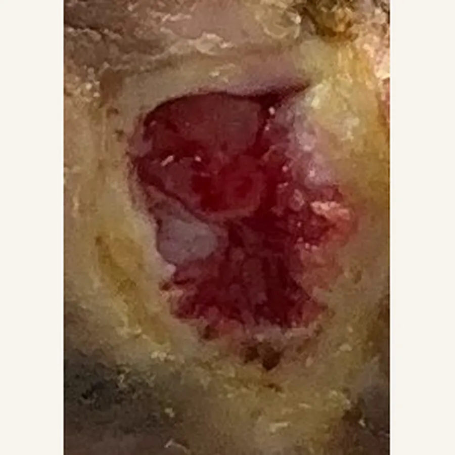 Clinical photograph of a diabetic plantar wound at visit 3, HKL-86