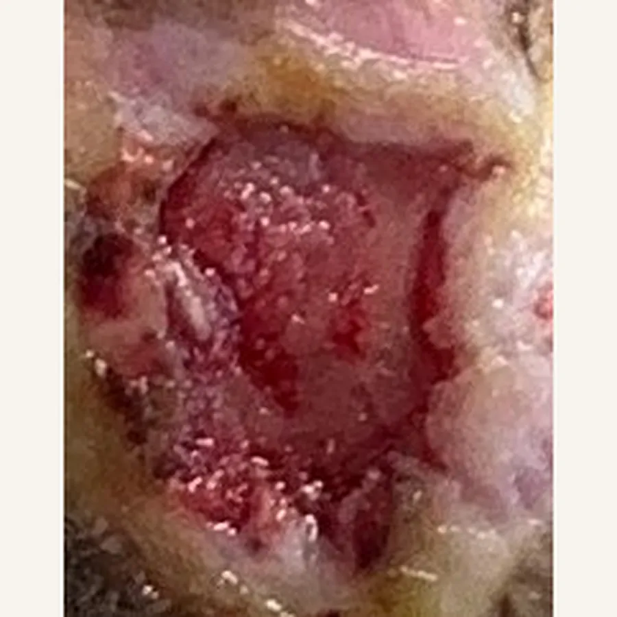 Clinical photograph of a diabetic plantar wound at visit 4, HKL-86