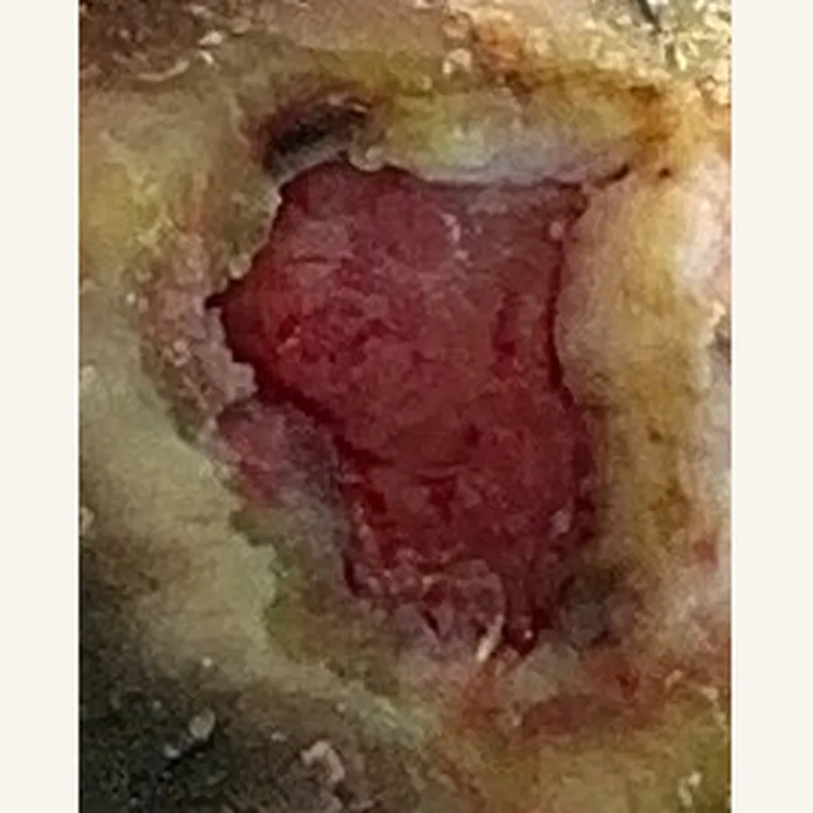 Clinical photograph of a diabetic plantar wound at visit 5, HKL-86