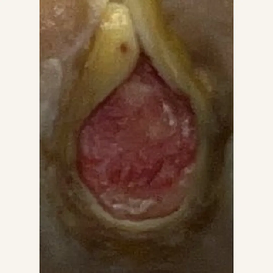 Clinical photograph of a diabetic plantar wound at visit 1, HKL-87