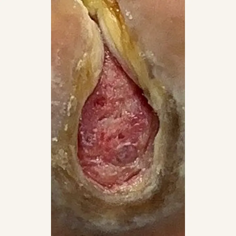 Clinical photograph of a diabetic plantar wound at visit 2, HKL-87