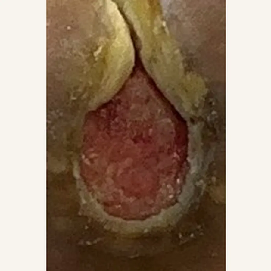 Clinical photograph of a diabetic plantar wound at visit 3, HKL-87
