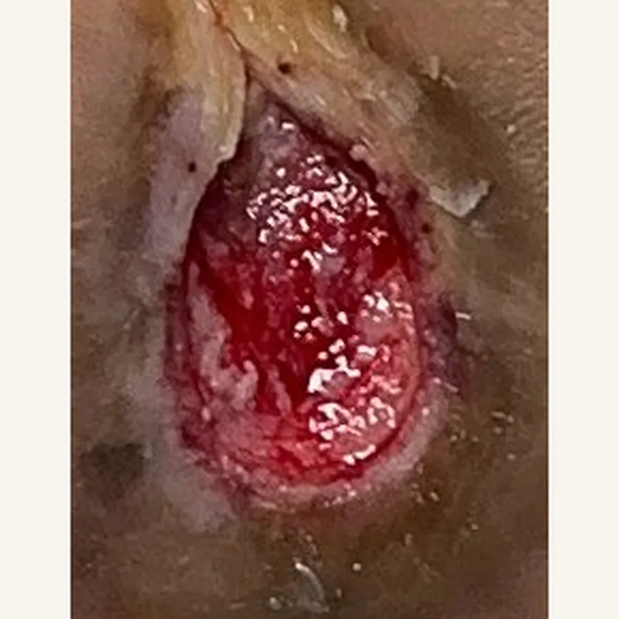 Clinical photograph of a diabetic plantar wound at visit 4, HKL-87