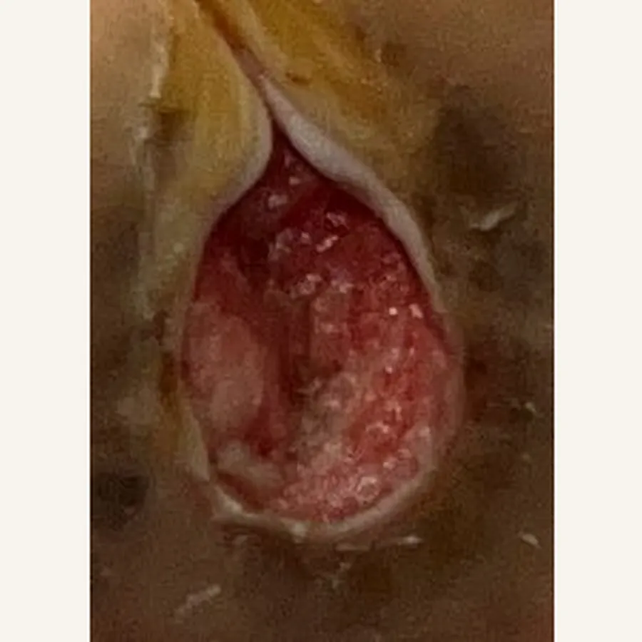 Clinical photograph of a diabetic plantar wound at visit 5, HKL-87
