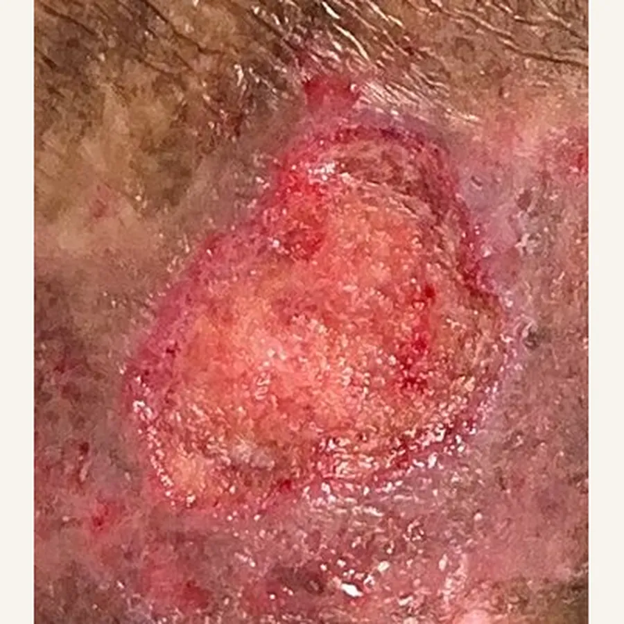 Clinical photograph of a lymphovascular leg wound at visit 1, HKL-88