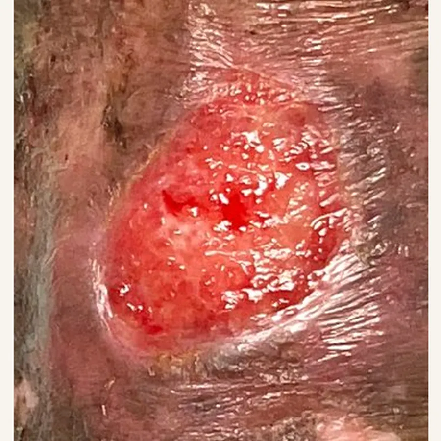 Clinical photograph of a lymphovascular leg wound at visit 2, HKL-88