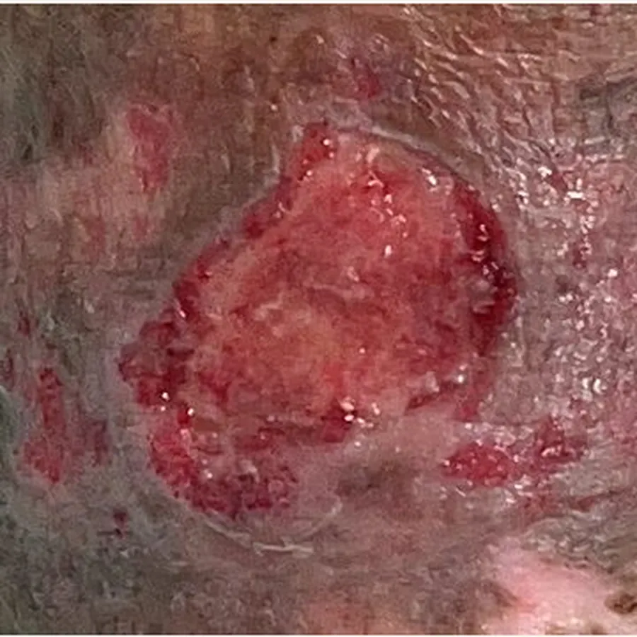 Clinical photograph of a lymphovascular leg wound at visit 3, HKL-88